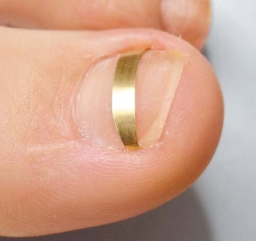 Voorbeeld nagelbeugel goud