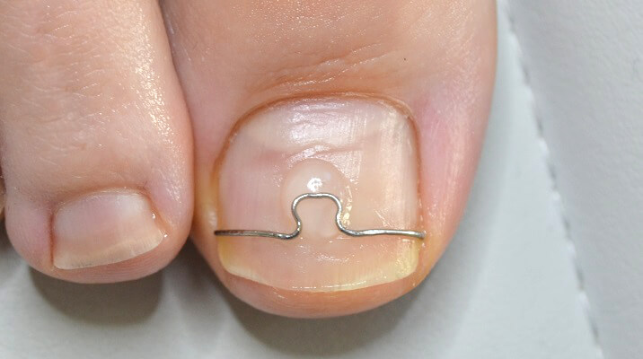 Voorbeeld nagelbeugel omega