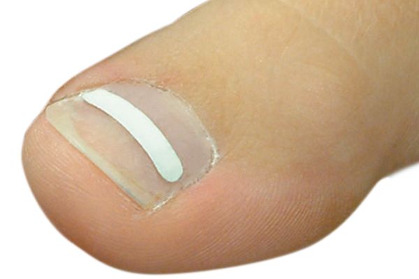 Voorbeeld nagelbeugel